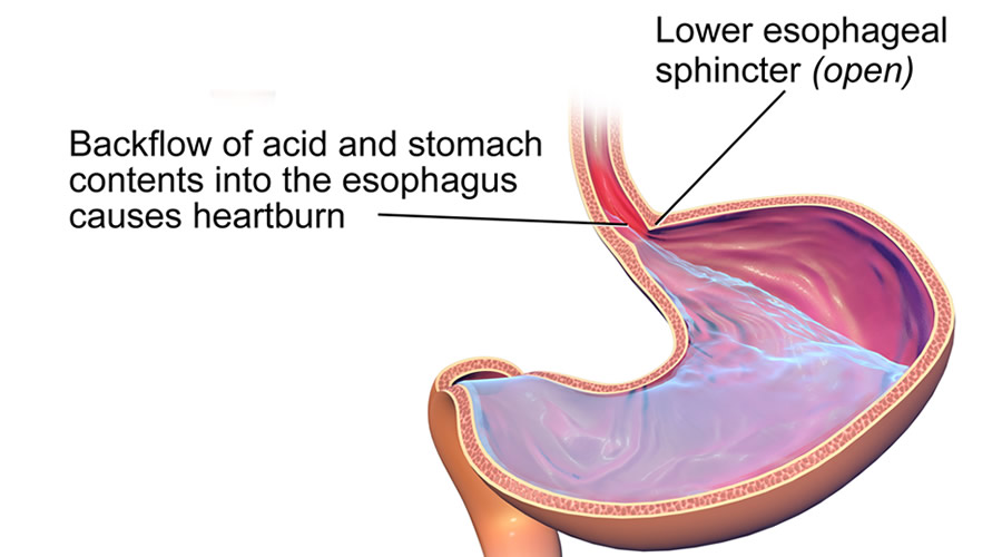 heartburn-2